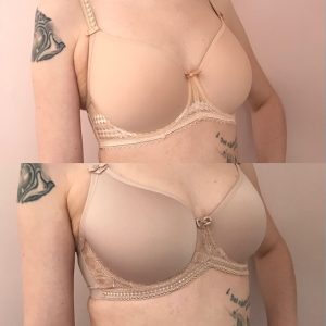 Breast Reduction, Breast Augmentation, and Bra Fitting - Broad Lingerie